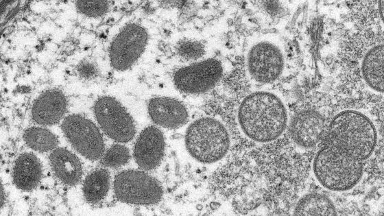 This undated electron microscopic (EM) handout image provided by the Centers for Disease Control and Prevention depicts a monkeypox virion, obtained from a clinical sample associated with the 2003 prairie dog outbreak. It was a thin section image from a human skin sample. On the left were mature, oval-shaped virus particles, and on the right were the crescents, and spherical particles of immature virions. (Photo by Cynthia S. Goldsmith / Centers for Disease Control and Prevention / AFP) / RESTRICTED TO EDITORIAL USE - MANDATORY CREDIT "AFP PHOTO / CYNTHIA S. GOLDSMITH, RUSSELL REGNERY / CENTERS FOR DISEASE CONTROL AND PREVENTION " - NO MARKETING - NO ADVERTISING CAMPAIGNS - DISTRIBUTED AS A SERVICE TO CLIENTS - RESTRICTED TO EDITORIAL USE - MANDATORY CREDIT "AFP PHOTO / Cynthia S. Goldsmith, Russell Regnery / Centers for Disease Control and Prevention " - NO MARKETING - NO ADVERTISING CAMPAIGNS - DISTRIBUTED AS A SERVICE TO CLIENTS /